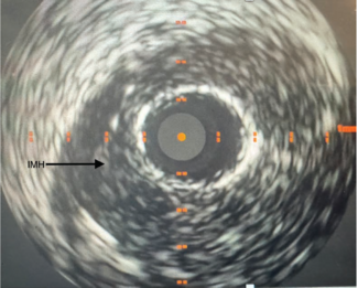 Agrawal CLD Jan 2025 Figure 3. Intravascular ultrasound showed a large intramural hematoma in the distal right coronary artery.