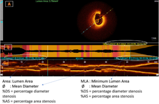 Figure 1. Pre-post optical coherence tomography analysis pullback. From: Jha et al, VDM May 2024 issue