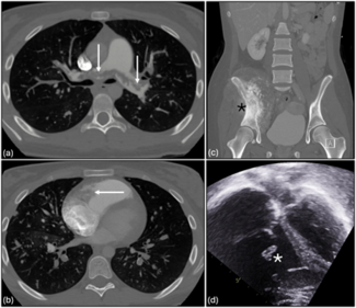 Krebushevski Figure 1