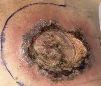 pyoderma gangrenosum