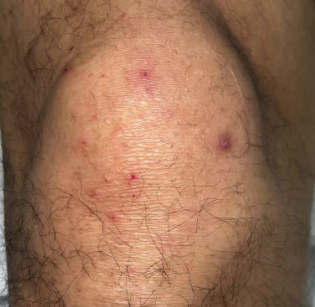 Scattered, nonblanchable erythematous to violaceous papules present over the proximal lower extremity. 