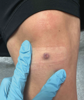 pink papule with a central dimple on the right knee