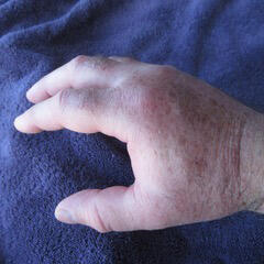 swollen hands