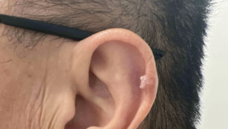 A firm, crusted papule on the left ear