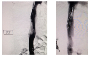 VentiV Clinical Images