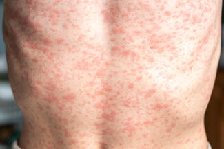 measles rash on a patient's back 