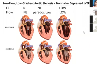 Kern Stenotic Aortic Valve (Pt II)