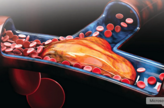 A Different Kind of Stroke