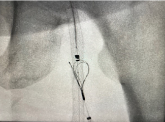 Golzar CLD May 2025: The ENDOCROSS device in the proximal SFA artery with the snare open on the femoral vein prior to creating the artery-to-vein anastomosis.