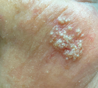 Lesion on the right cheek