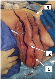 Necrotizing soft tissue infection zones of infection: