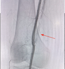 DETOUR System clinical image, CLD June 2025 Ali et al