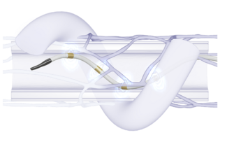 Symplicity Spyral renal denervation