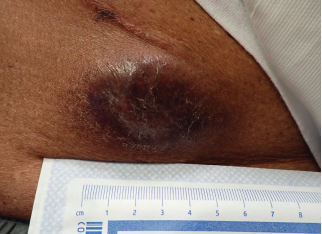 Clinical presentation of the left lower abdomen