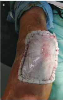 Intraoperative photograph after repair with dermal matrix.