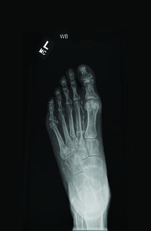 x-ray of foot metatarsals