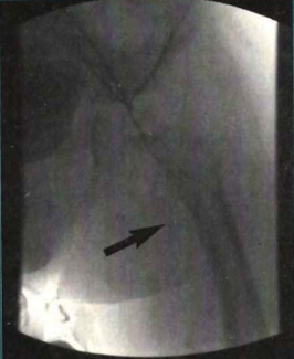 Catheter-Directed Thrombolysis and Percutaneous Thrombectomy for Acute Arterial Ischemia in Children