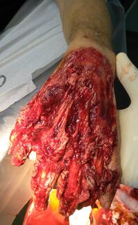 hand after trauma from industrial cotton cutting machine