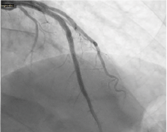 Figure 9, Case 3. Proximal-mid stents overlap optimization with Takeru™’s 4 mm NC balloon (9A) (with three overlapping stents already in place) and excellent final angiographic result (9B).
