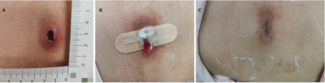 Figure 2. (A) Cutaneous abscess wound before closure after wound bed preparation. (B) Closure of the abscess wound with the novel zipper device. (C) Wound healing 5 days after zipper application.