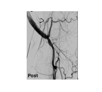 Figure 4 Angiography confirming flow restoration at the distal graft anastomosis and outflow in the profunda.