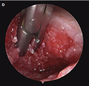 A sinus wound is cleaned with endoscopy until there is fresh bleeding.