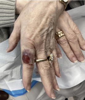  Large, erythematous lesion