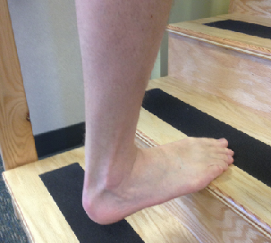 Achilles tendinopathy