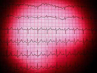 tachycardia