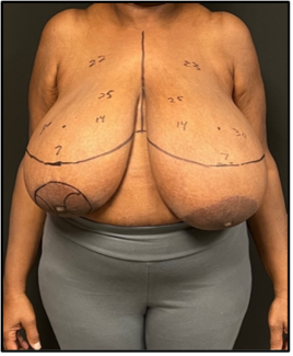 Figure 1. Preoperative markings in a patient with left-sided breast cancer. 