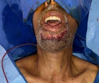 Preoperative photograph demonstrating a 3.5 x 3.5-cm exophytic cutaneous mass located in the midline of the chin consistent with biopsy-proven metastatic hepatocellular carcinoma.