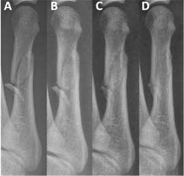 Figure 1. AP radiographs of the right foot fifth metatarsal. A: 1 day post-injury. B: 1 month. C: 4 months. D: 11 months.
