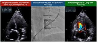 Rodes-Cabau Figure 2