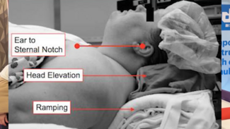 Pediatric Video Tutorial: Peds Obesity: Airway Airway Airway