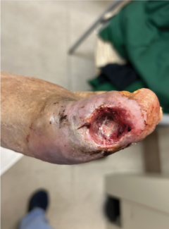 Modified Masquelet Technique with Resorbable Antibiotic Cement and Biologic Dressings
