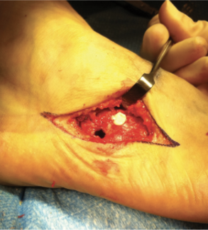 The Troublesome Tarsometatarsal 4-5 Joint: An Unrecognized Condition in Lateral Midfoot Pain