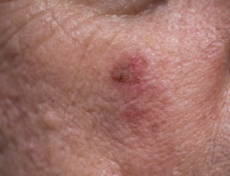 Actinic Keratosis