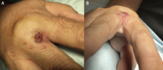 Figure 1. A dorsal lesion  containing a sinus tract  (A) is seen in the interdigital  web space (B)