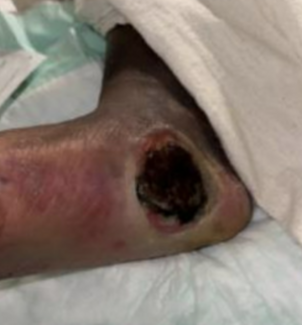 Initial presentation of necrotizing fasciitis in the lower extremity