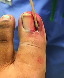 Use of phenol to cauterize the root of an ingrown nail at the medial border
