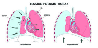 Tension pneumothorax