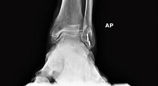 Radiographic view of ankle osteoarthritis with joint space narrowing