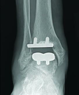 anteroposterior x-ray view of a total ankle replacement