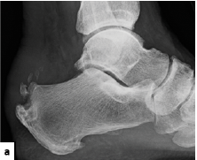 lateral xray view of the heel and ankle with spurring