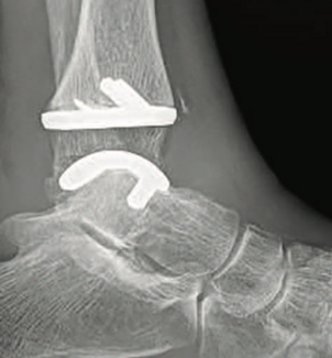 lateral radiographic view of a total ankle replacement with hardware visible