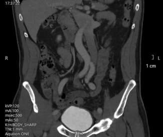 Chan Figure 2A. Coronal plane image from the patient’s computed tomography venogram