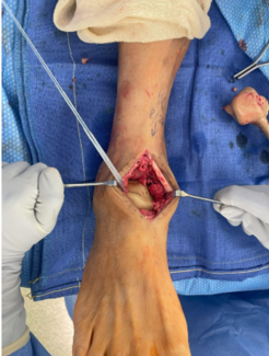 intraoperative photo of a total talar replacement with instrumentation