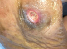 diabetic foot ulcer on the plantar aspect of the foot