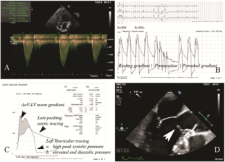 Rafique Figure. Cardiac imaging and catheterization findings