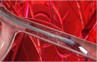 VentiV Mechanical Thrombectomy system illustration